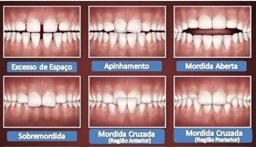 Tratamento com alinhador ortodôntico invisível - Clínica Oral Premium