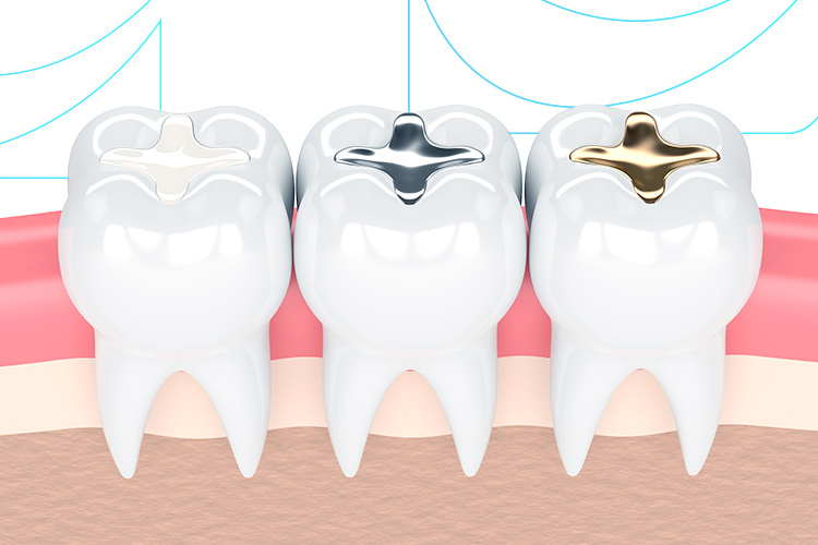 Ilustração com restauração dentária de ouro, prata e resina.